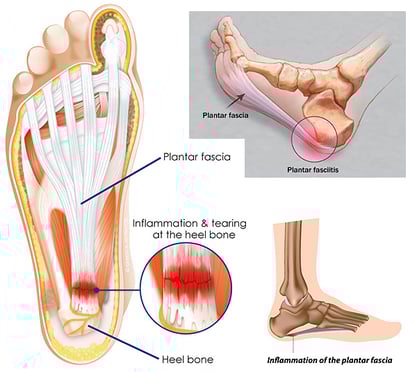 anatomía de la fascia plantar - fascitis