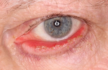 Ausgeprägtes Ektropium mit Auswärtsdrehung des Unterlides