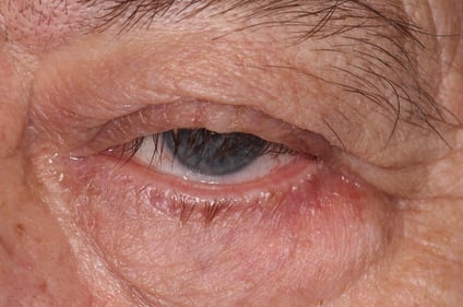 Ptosis mit Verlegung der zentralen Sichtachse (Pupille bedeckt)