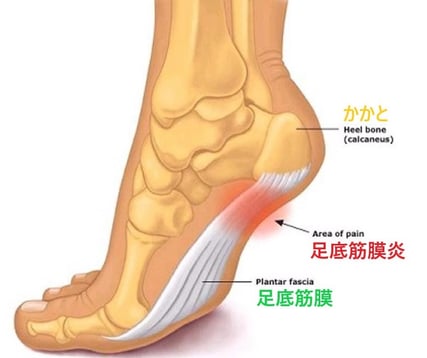 ドクターバンカイロプラクティック：Dr.Ban Chiropractic in Osaka：足底筋膜炎