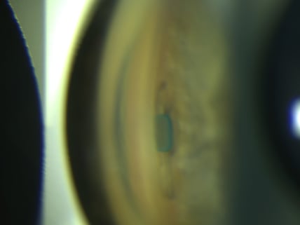 Implantierter Stent nach einer Woche. Man sieht den grünen Ring, der gerade noch in der Vorderkammer sichtbar sein soll.