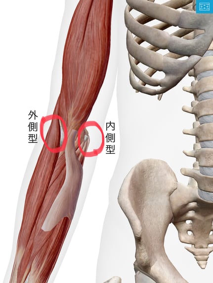 野球肘 リトルリーガーズエルボー