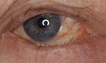 Ausgeprägtes Entropium mit Einwärtsdrehung des Unterlides und Wimpernkontakt der Augenoberfläche