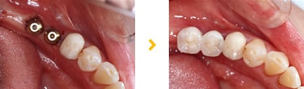 インプラント埋込　