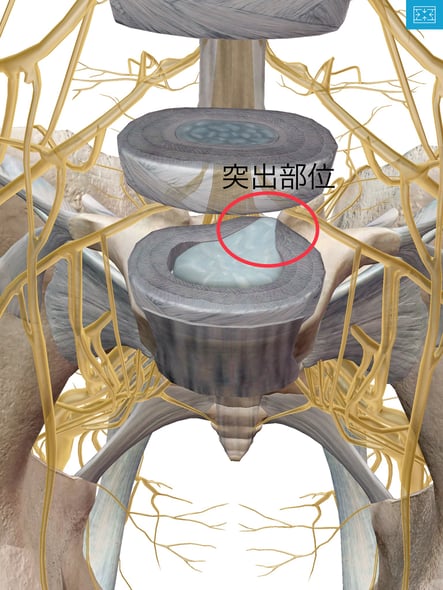 腰の痛み 腰椎ヘルニア