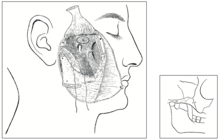 Fig. 1 — L’intervention de W. Rose permettant d’accéder au foramen ovale après dissection du nerf mandibulaire [12]