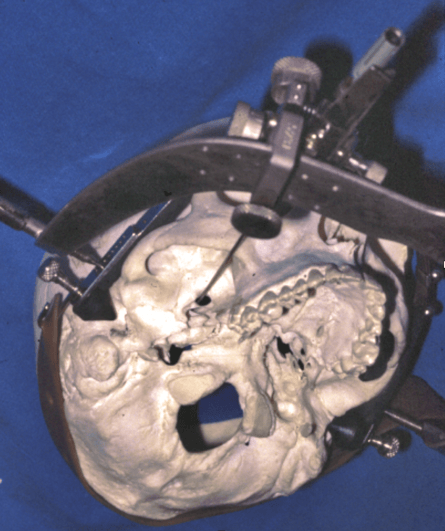Fig. 6 — Cadre de stéréotaxie permettant de guider une trajectoire vers le foramen oval