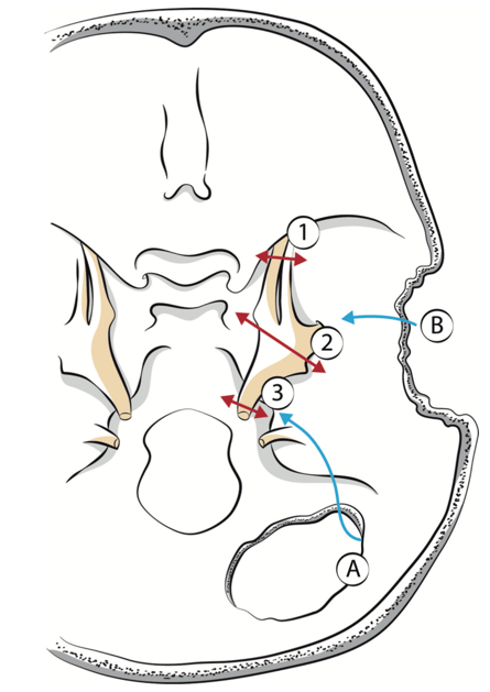 Fig. 4 – Les différentes voies d’abord du ganglion de Gasser (A) la voie sous-occipitale ; (B) la voie sous-temporale; (1) la neurotomie ; (2) la gassérectomie; (3) la neurotomie rétrogassérienne.