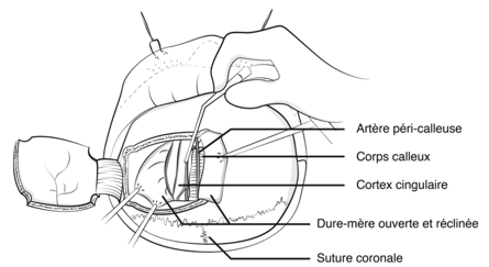 Fig. 1 — La cingulectomie : une intervention de psychochirurgie dans le traitement de la composante émotionnelle de la douleur