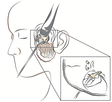 Fig. 2 — Intervention de neurotomie rétrogassérienne par voie sous-temporale