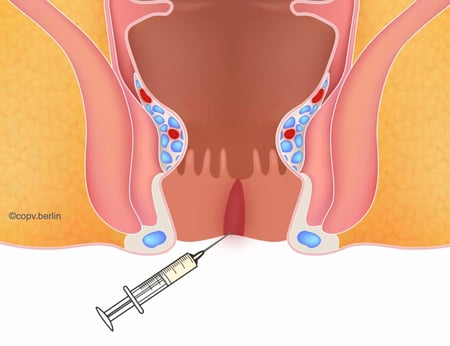 Botox Injektion in den inneren Schließmuskel bei Analfissuren - Proktologie Berlin
