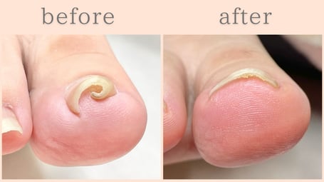 焼津市 巻き爪 巻き爪補正 ビフォーアフター