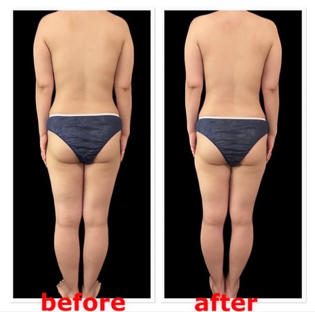 板橋区にあるリンパマッサージ専門店ファリンソの男性セラピストが施術したビフォーアフター後ろからみた写真