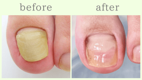 浜松市 爪甲鉤彎症 分厚い爪 肥厚爪 ビフォーアフター
