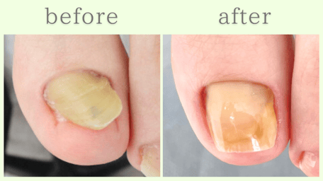 浜松市 爪甲鉤彎症 分厚い爪 肥厚爪 ビフォーアフター