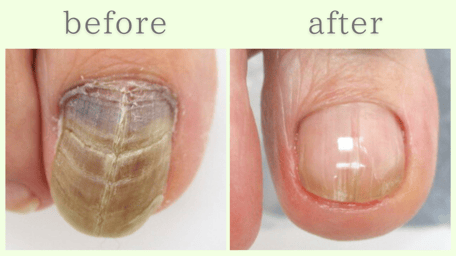 藤枝市 爪甲鉤彎症 分厚い爪 肥厚爪 ビフォーアフター