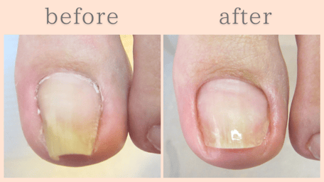 焼津市 巻き爪 巻き爪補正 ビフォーアフター