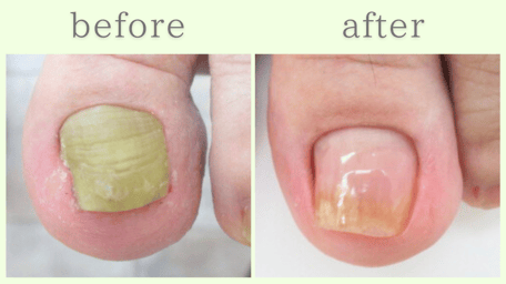浜松市 爪甲鉤彎症 分厚い爪 肥厚爪 ビフォーアフター