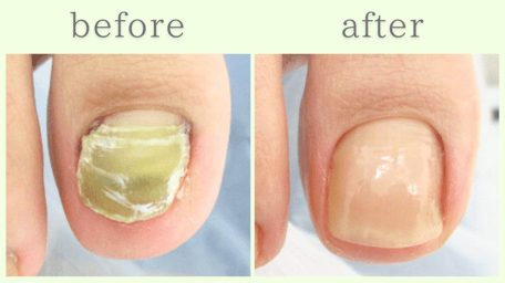 藤枝市 爪甲鉤彎症 分厚い爪 肥厚爪 ビフォーアフター