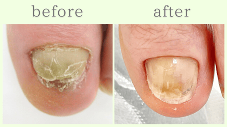 牧之原市 爪甲鉤彎症 分厚い爪 肥厚爪 ビフォーアフター