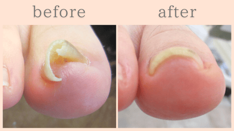 磐田市 巻き爪 巻き爪補正 ビフォーアフター