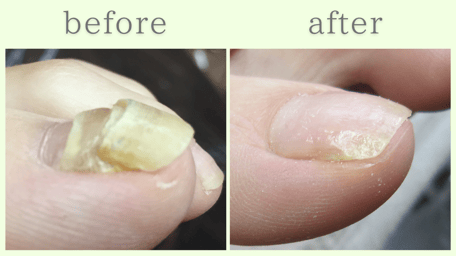 焼津市 爪甲鉤彎症 分厚い爪 肥厚爪 ビフォーアフター