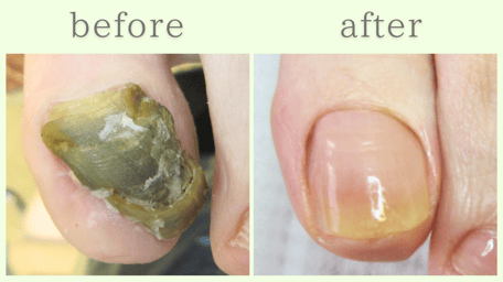 焼津市 爪甲鉤彎症 分厚い爪 肥厚爪 ビフォーアフター