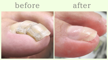 掛川市 爪甲鉤彎症 分厚い爪 肥厚爪 ビフォーアフター
