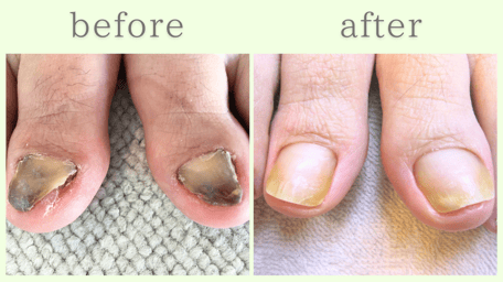 牧之原市 爪甲鉤彎症 分厚い爪 肥厚爪 ビフォーアフター