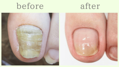 掛川市 爪甲鉤彎症 分厚い爪 肥厚爪 ビフォーアフター