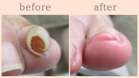 島田市 巻き爪 巻き爪補正 ビフォーアフター