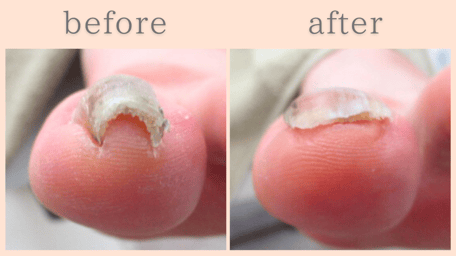 島田市 巻き爪 巻き爪補正 ビフォーアフター