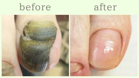 焼津市 爪甲鉤彎症 分厚い爪 肥厚爪 ビフォーアフター