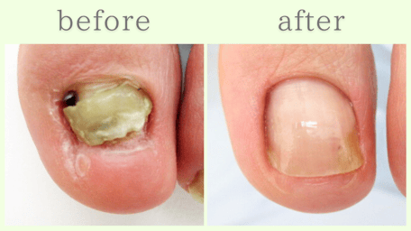 島田市 爪甲鉤彎症 分厚い爪 肥厚爪 ビフォーアフター