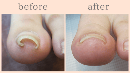 焼津市 巻き爪 巻き爪補正 ビフォーアフター