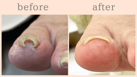 焼津市 巻き爪 巻き爪補正 ビフォーアフター