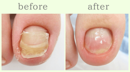 島田市 爪甲鉤彎症 分厚い爪 肥厚爪 ビフォーアフター