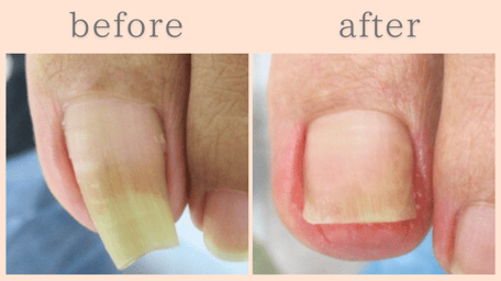 島田市 巻き爪 巻き爪補正 ビフォーアフター