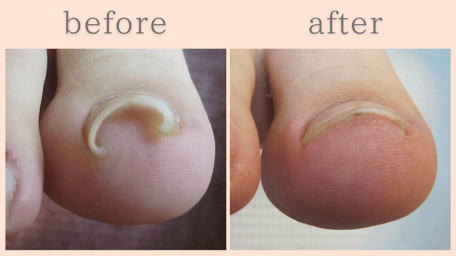 焼津市 巻き爪 巻き爪補正 ビフォーアフター