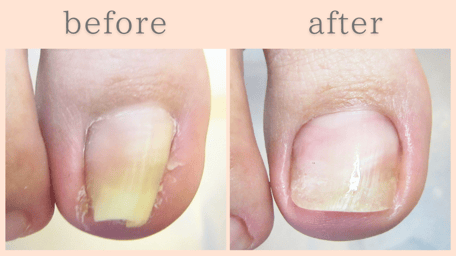 焼津市 巻き爪 巻き爪補正 ビフォーアフター