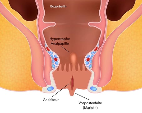 Chronische Analfissur - COPV Berlin Proktologie 