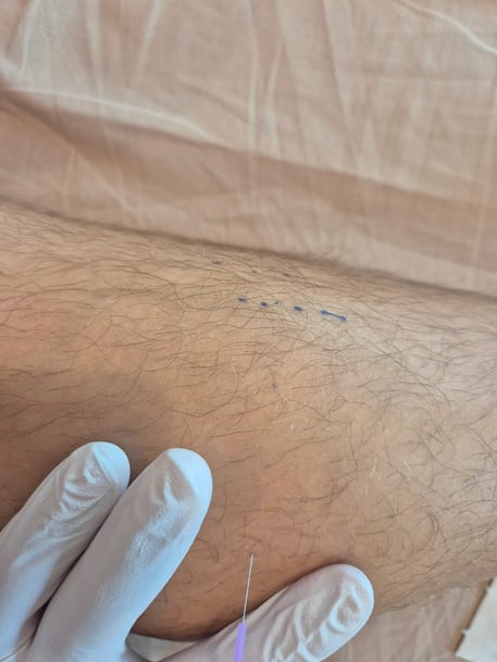 Dry Needlings Therapie basel