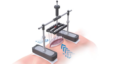Fasciotens Abdomen 3D Modell, Anwendung am Patienten
