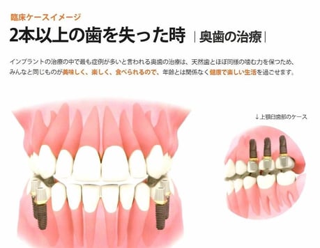 奥歯のインプラント 永井歯科医院 茨木市