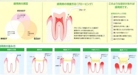 歯周病治療 永井歯科医院 茨木市