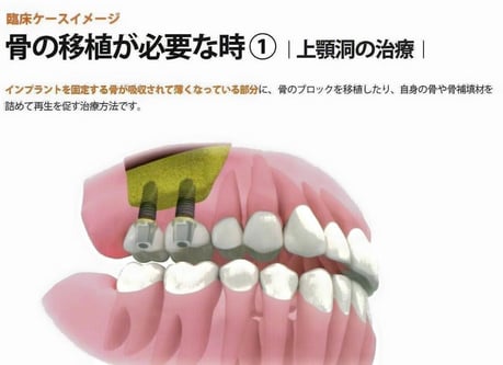 サイナスリフト ソケットリフト 永井歯科医院 茨木市 診療科目