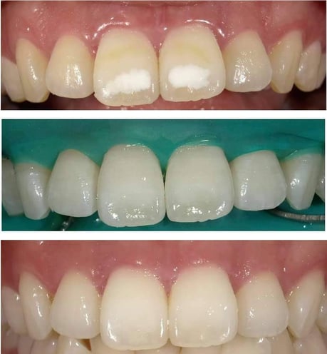 ホワイトスポット治療 大阪府 永井歯科医院 エナメル質形成不全症