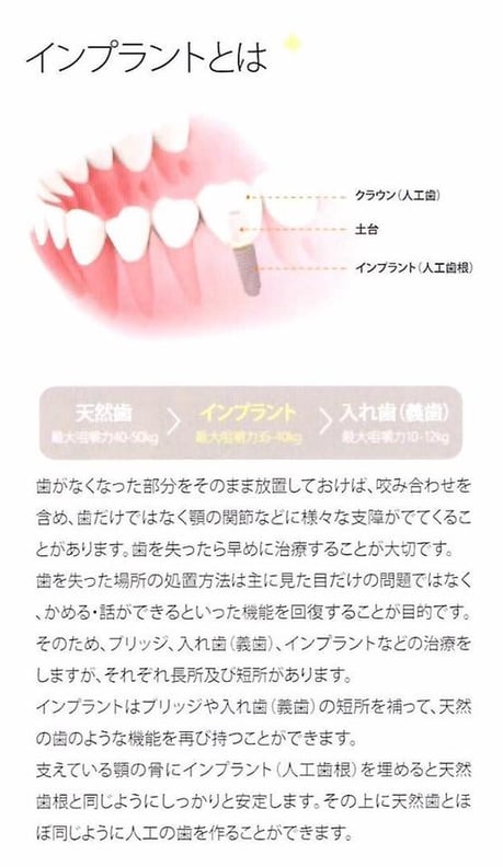インプラント 茨木市 永井歯科医院 説明