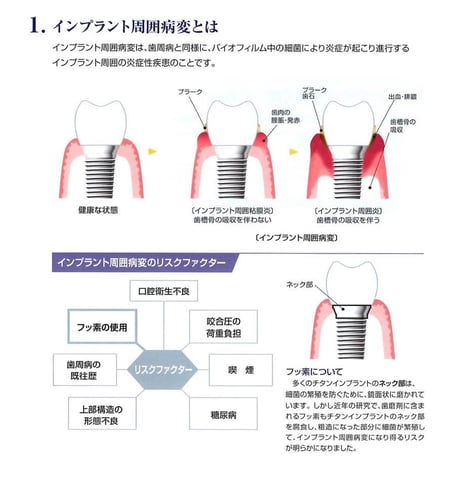 永井歯科医院 インプラント周囲炎とは