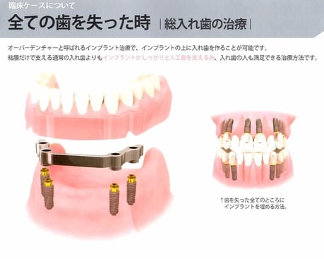 総入れ歯 インプラントオーバーデンチャー 茨木市 永井歯科医院